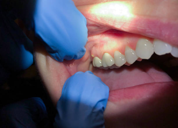 Best Emergency Treatment for Dental Infections or Abscesses in Chouteau, OK